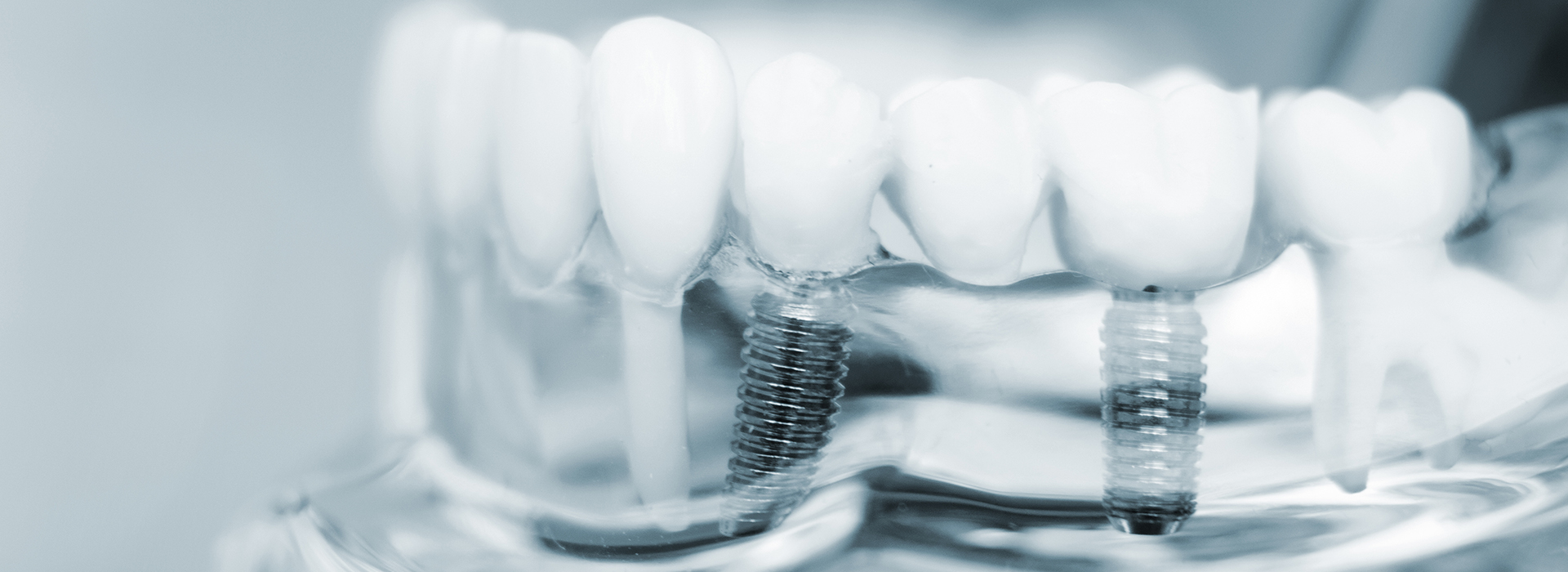 Implant Dentist in Woodbridge