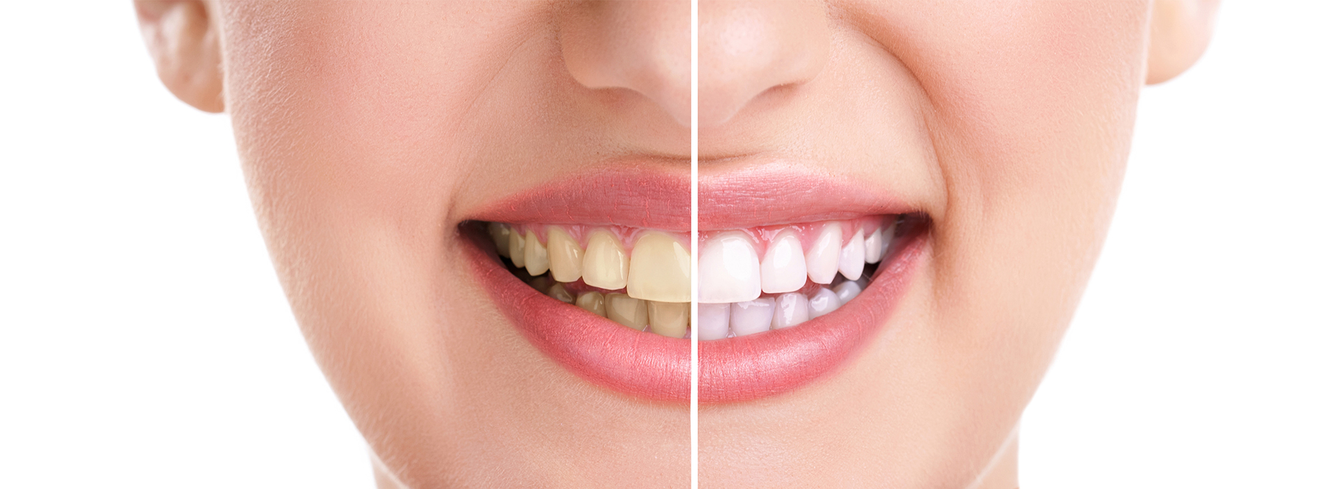 Teeth Whitening near Woodbridge